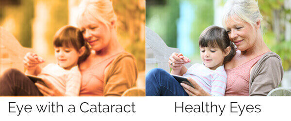Cataract Surgery Jacksonville Cataract Surgery Diagram