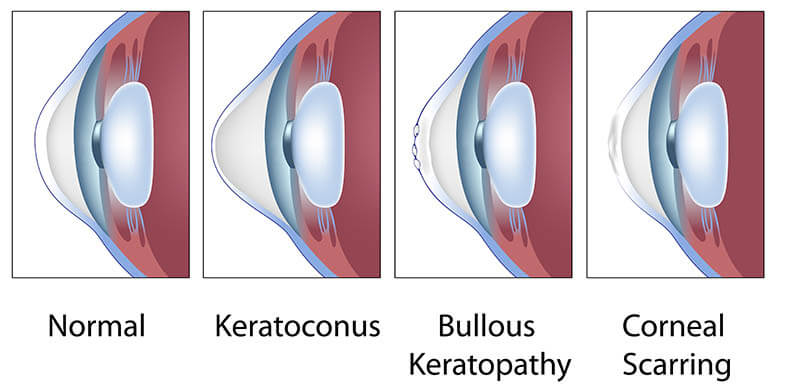 Chart Illustrating various corneal conditions; Normal eye, keratoconus, bullous keratopathy, corneal scarring
