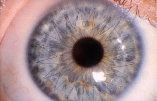 Closeup of an Eye With Corneal Crosslinking