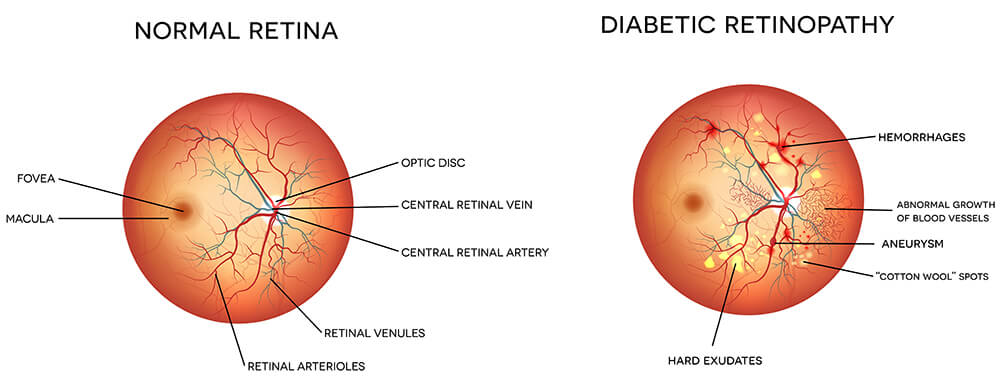 Chart Illustrating a Normal Retina vs One Experiencing Diabetic Retinopathy