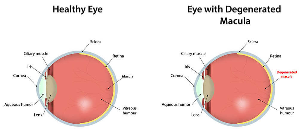 Chart Illustrating a Healthy Eye Vs One With Degenerated Macula